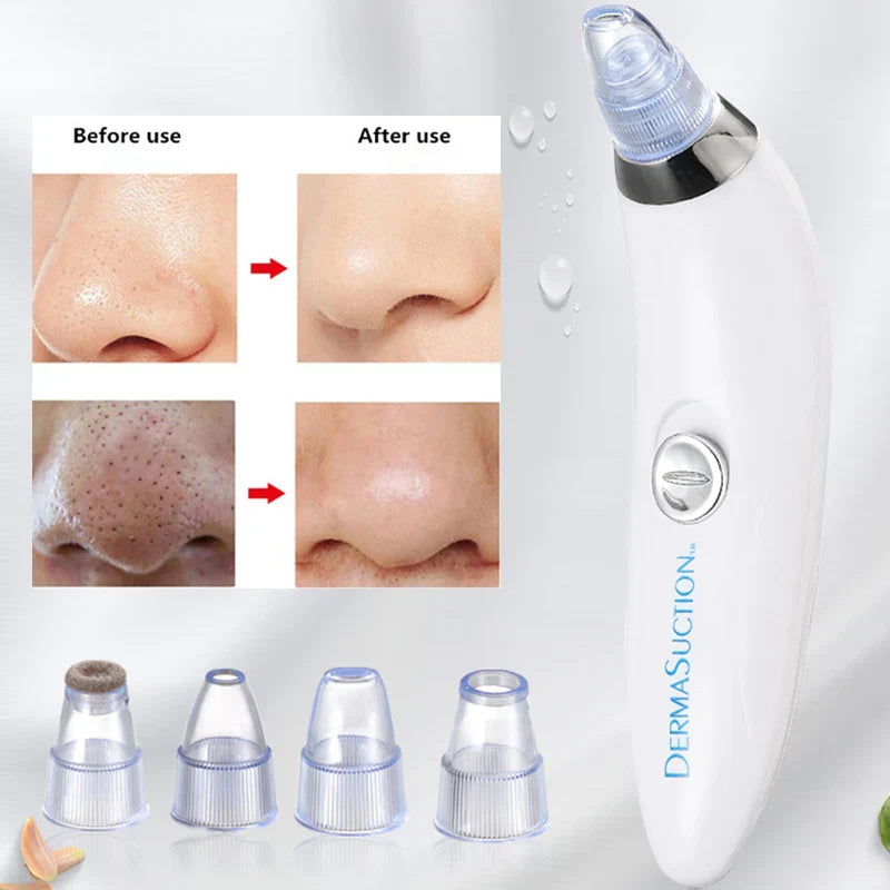 Blackhead and Acne Suction & PoresCleaner
